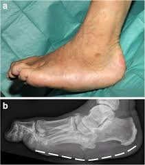 Charcot Foot