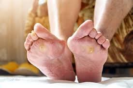 Foot Ulcers