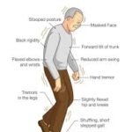 Parkinson’s Disease