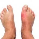 Peripheral Neuropathy