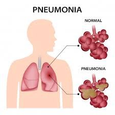 Pneumonia