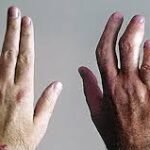 Psoriatic Arthritis