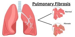 Pulmonary fibrosis