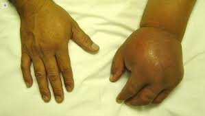 Reflex Sympathetic Dystrophy